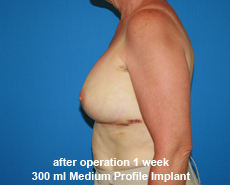 plastic-surgery-breast-augmentation